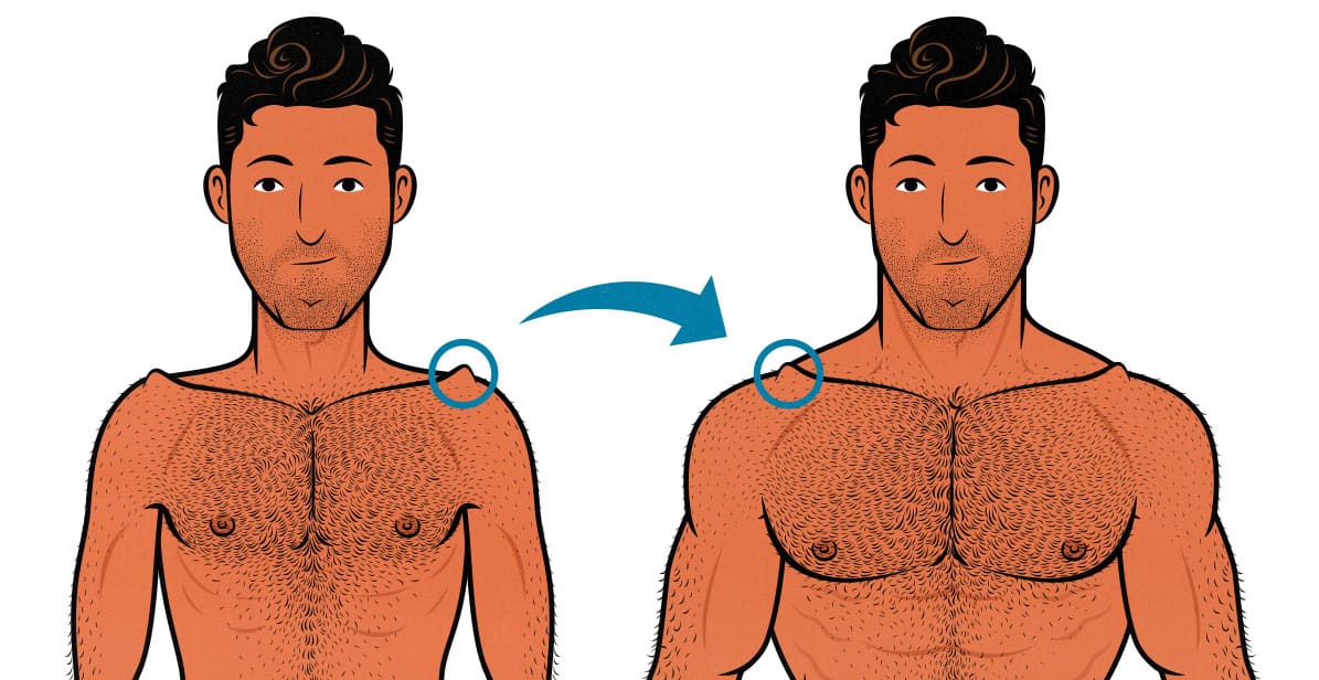 Diagram showing how to get rid of a prominent shoulder bone bump (acromioclavicular joint) by building muscle.