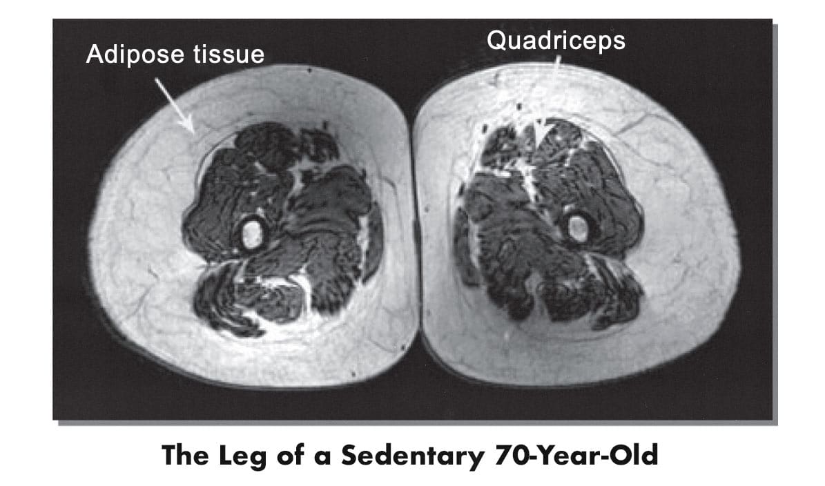 MRI scan showing the muscle and fat mass of a typical 70-year-old.