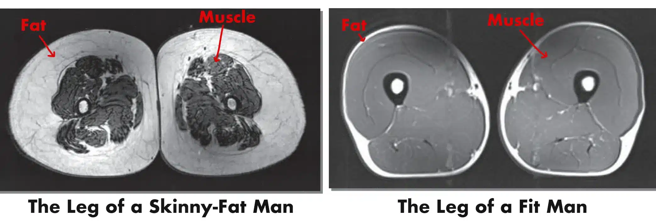 MRI scan showing the body composition of a skinny-fat man.