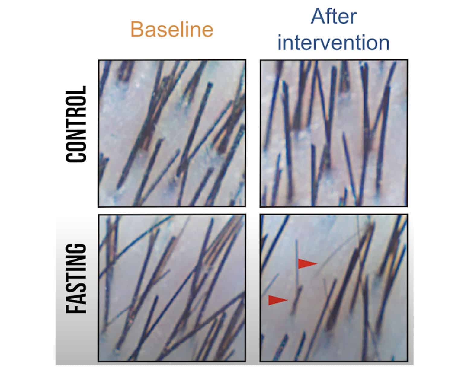 Before and after photo from a study showing that intermittent fasting can cause hair loss in men and women.