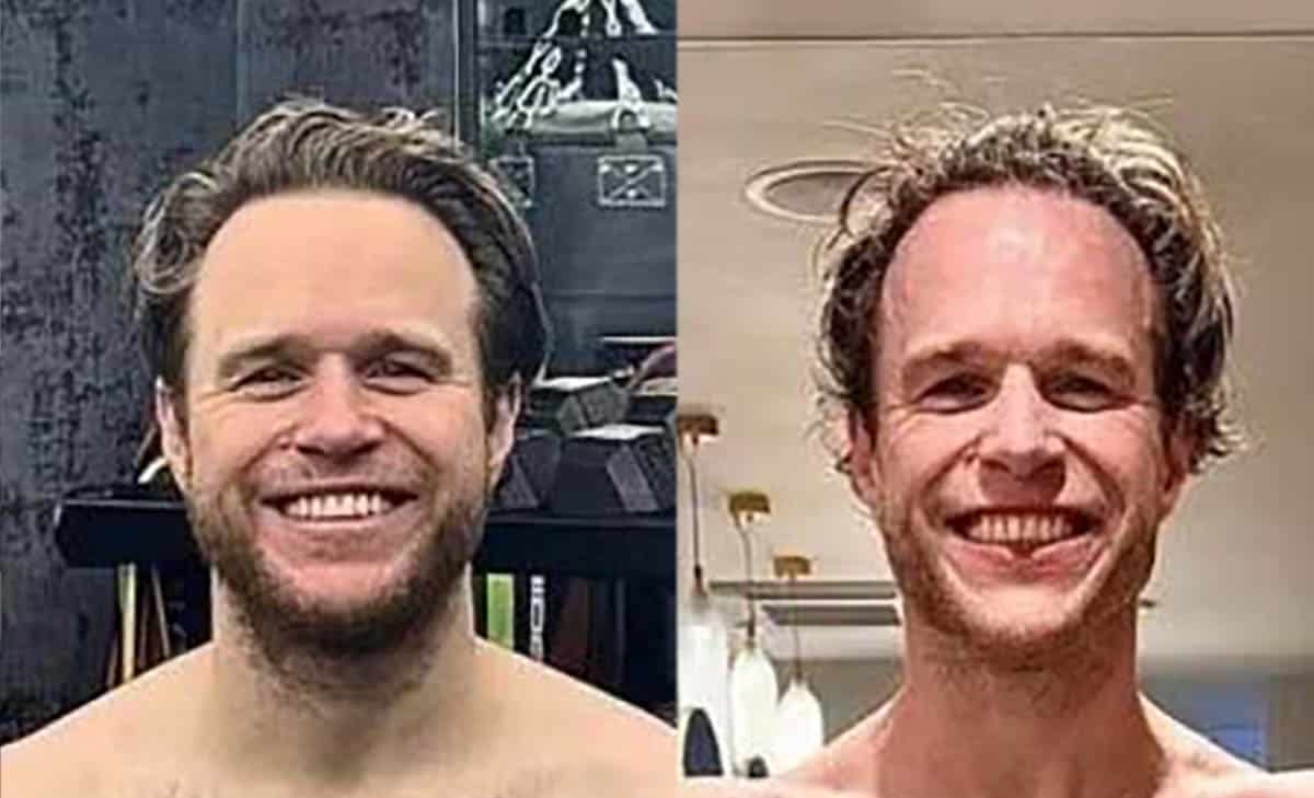 Photo showing the bodybuilding "death face" or the celebrity "Ozempic face."
